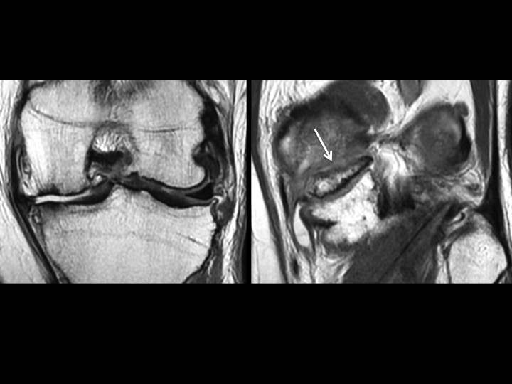 Figure 3 for case meniscal ossicle